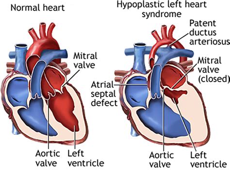 hypoplastic left sided heart syndrome